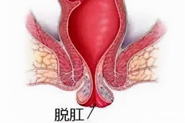 肛门症状排便失禁怎么办_肛门失禁的症状不排便_肛门大便失禁吃什么药