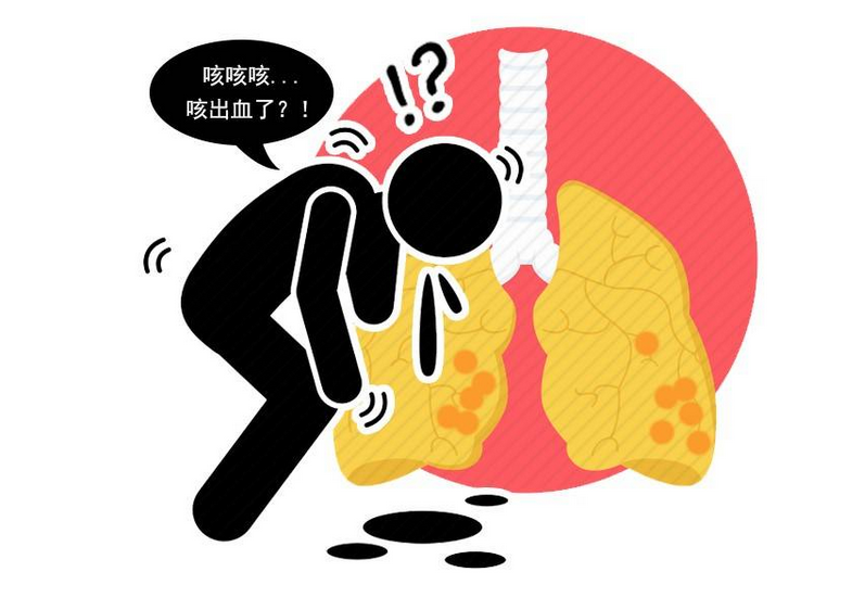 肺结核严重吗会死人吗_肺结核严重吗?_肺结核严重不