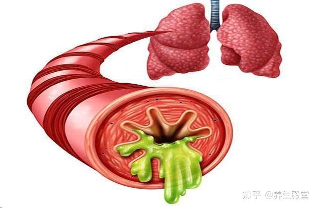 支气管炎治疗方法_只气管炎_炎症支气管炎