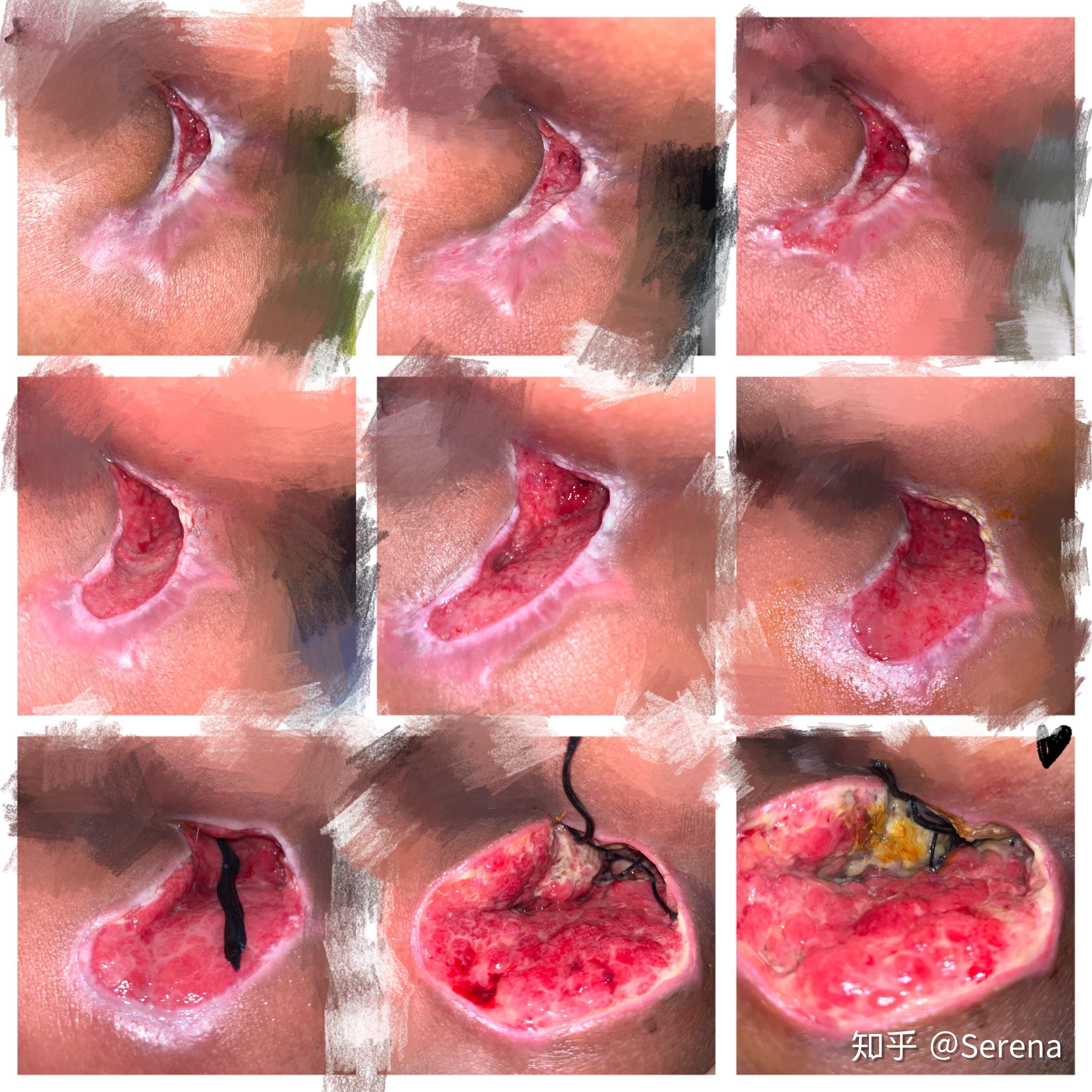 肛瘘手术住院时间-肛瘘手术的哭笑不得：住院经历与病友的战斗故事