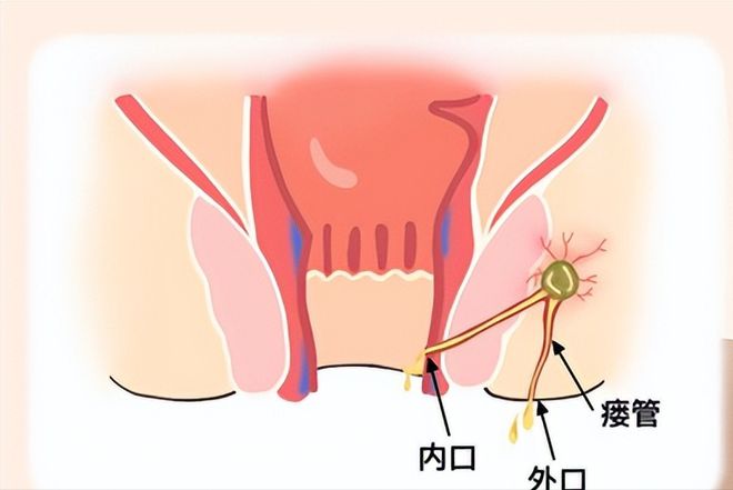 肛瘘手术住院几天可以做手术_住院手术肛瘘时间多长_肛瘘手术住院时间