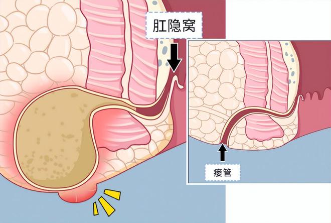 住院手术肛瘘时间多长_肛瘘手术住院几天可以做手术_肛瘘手术住院时间