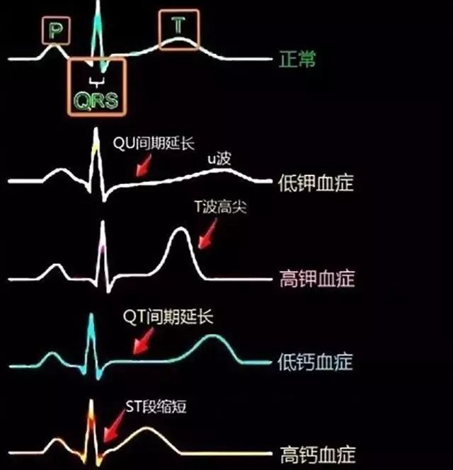 护理冠心病要点有哪些_冠心病的护理要点_冠心病的护理