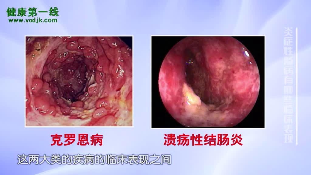罗克恩病能治好吗_罗克恩病早期症状_克罗恩病克罗恩肠炎治疗